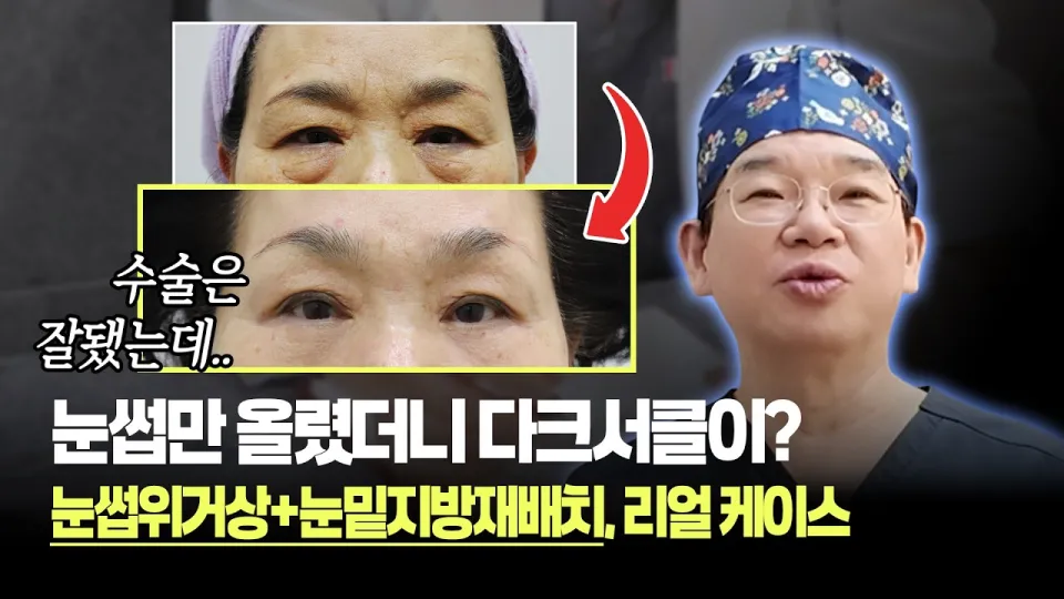 눈썹위거상 수술을 안전하게 하는 방법과 1년 후 관리법